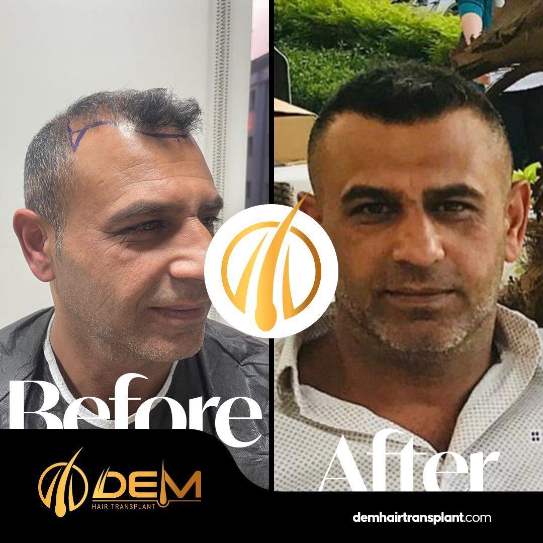 DEM sonuç 2